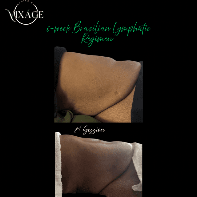 Brazilian Lymphatic Regimen at Bodied by Vixáge in Puyallup, WA